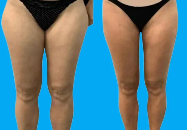 Résultats avant / après lipœdème – photo 1